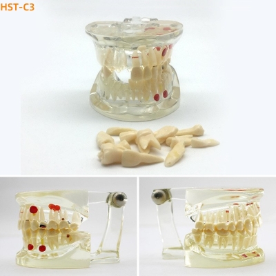 Dental Study Model Comprehensive Pathology Detachable Oral Teaching Model