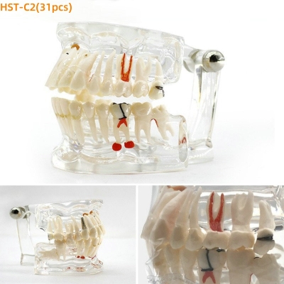 Dental Study Model Comprehensive Pathology Detachable Oral Teaching Model